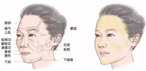 改良面部松弛的項(xiàng)目還有哪些