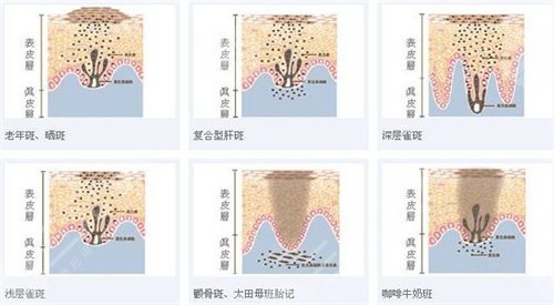 中國(guó)醫(yī)學(xué)科學(xué)院皮膚病醫(yī)院祛斑案例