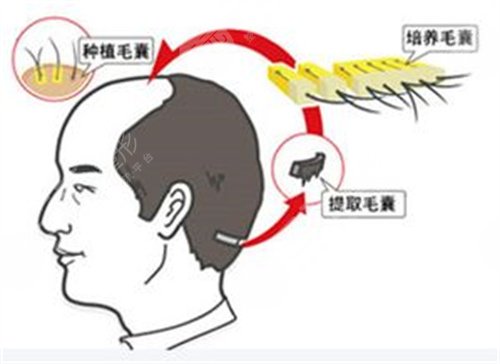 貴陽(yáng)碧蓮盛植發(fā)醫(yī)院發(fā)際線種植案例分享