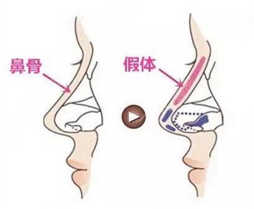 鼻翼縮小手術(shù)案例
