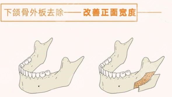 磨下頜角手術(shù)過程圖恢復(fù)記錄，真人下頜角磨骨對比圖~