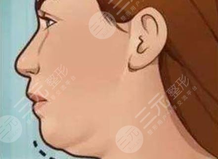 雙下巴