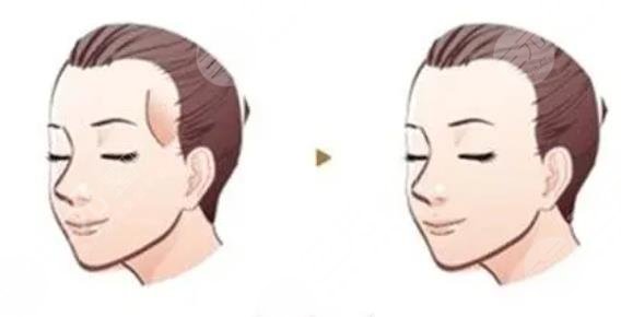 太陽穴凹陷