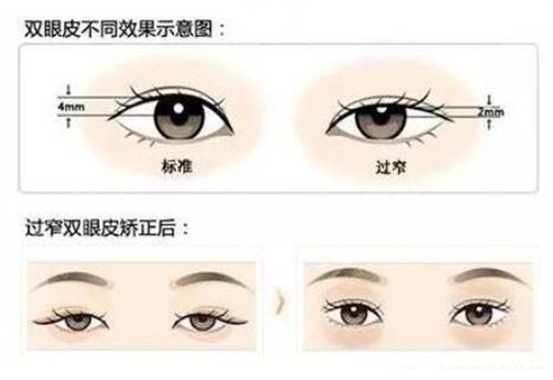 雙眼皮案例