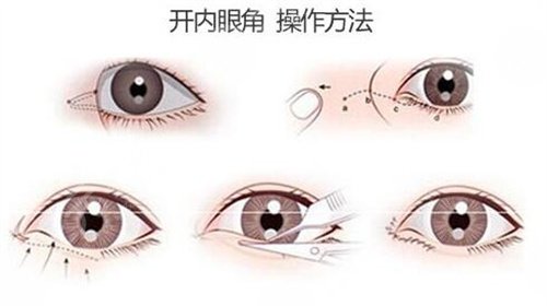 張冰潔修復(fù)眼角靠譜嗎?案例