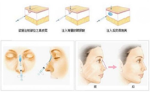 射頻除皺后一個(gè)月