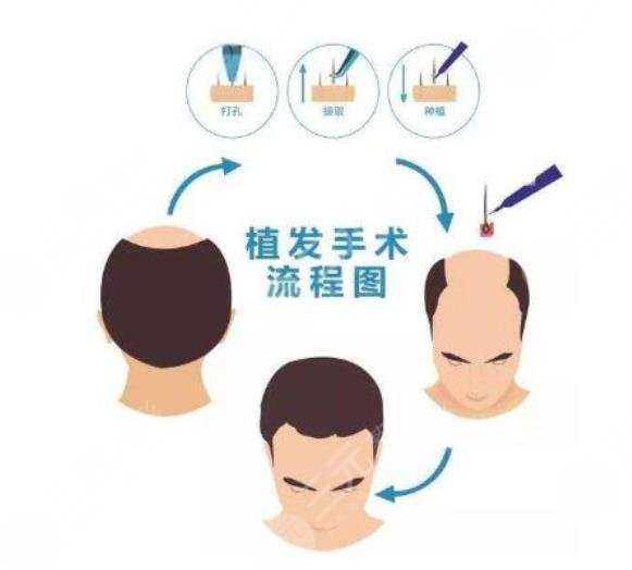 頭發(fā)種植技術(shù)手術(shù)操作過程