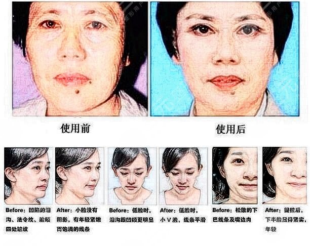 玻尿酸填充法令紋真實(shí)案例果圖：術(shù)前一天