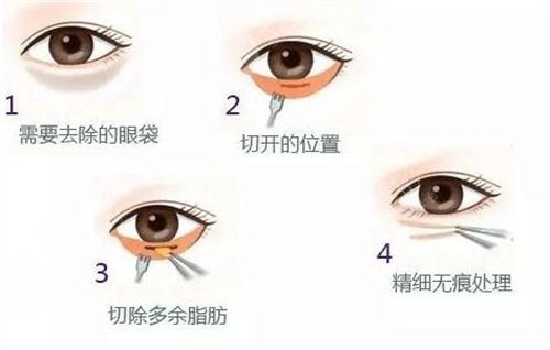 微創(chuàng)去眼袋一般適合什么年齡？任何年齡都可以做這項目嗎？