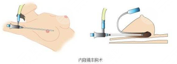內(nèi)窺鏡隆胸和普通隆胸有什么區(qū)別？?jī)?nèi)窺鏡隆胸恢復(fù)期要多久？?jī)r(jià)格表