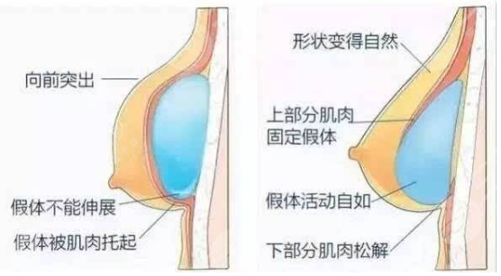 內(nèi)窺鏡隆胸和普通隆胸有什么區(qū)別？