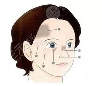 激光去痣