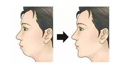 齙牙怎么矯正？如何解決齙牙這個問題，成為了他們的重中之重