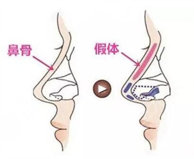 鼻翼修復(fù)手術(shù)