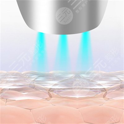 歐洲之星4d激光的適應癥狀有哪一些呢?