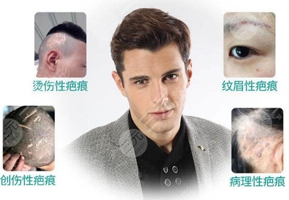 疤痕植發(fā)