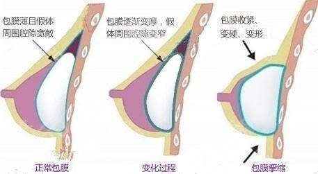 假體隆胸的注意事宜有哪些？