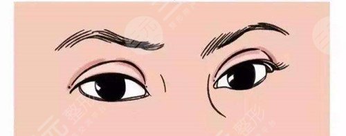 埋線雙眼皮