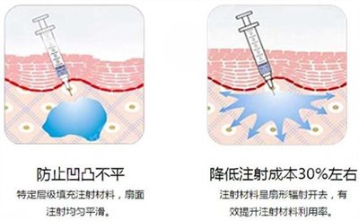 磨骨瘦臉對比圖，B****打幾次能定型?