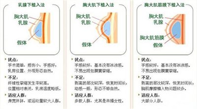 假體豐胸需要多少錢？豐胸前后對(duì)比果圖
