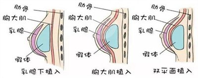 假體隆胸手術(shù)降低風(fēng)險(xiǎn)嗎?果好不好？隆胸手術(shù)對(duì)比圖片
