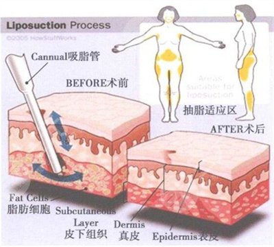 吸脂手術(shù)多久可以恢復(fù)?