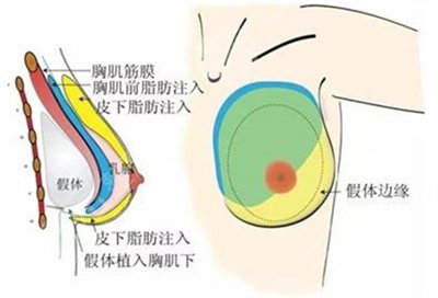 c罩杯多大胸圖片欣賞丨胸部整形手術(shù)之后需要注意什么？