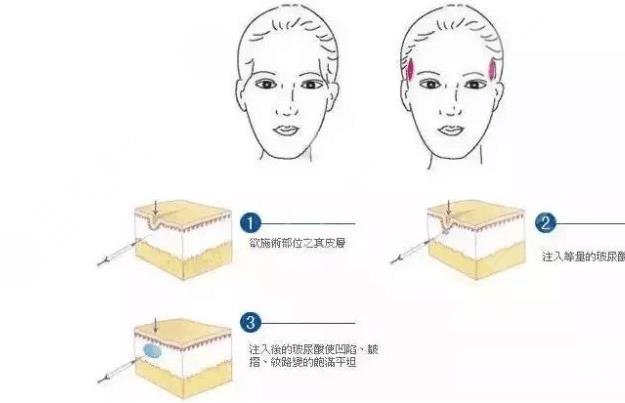 太陽穴