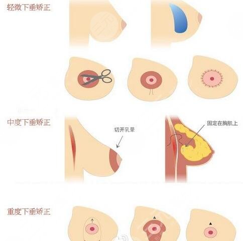 美國傲諾拉假體價格受到選擇醫(yī)院影響