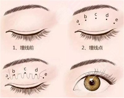 廣東省人民醫(yī)院美容科怎樣？坐診醫(yī)生介紹&埋線雙眼皮案例~