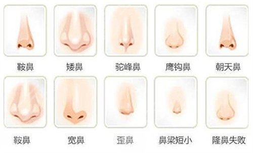 九院王濤隆鼻怎么樣？案例分享丨**改造我的塌鼻子！