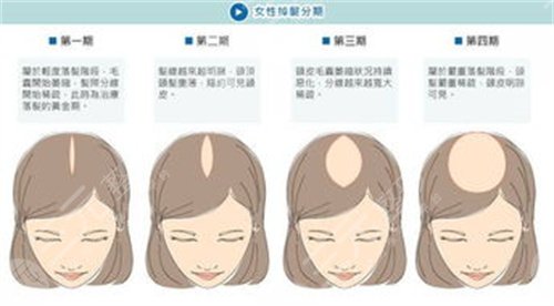 上海劍橋醫(yī)院植發(fā)怎么樣？植發(fā)醫(yī)生名單&植發(fā)案例果對比圖~