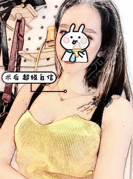 上海市棒棒糖法乳房縮小手術果圖