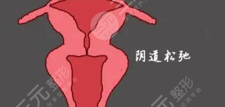 私密縮緊術