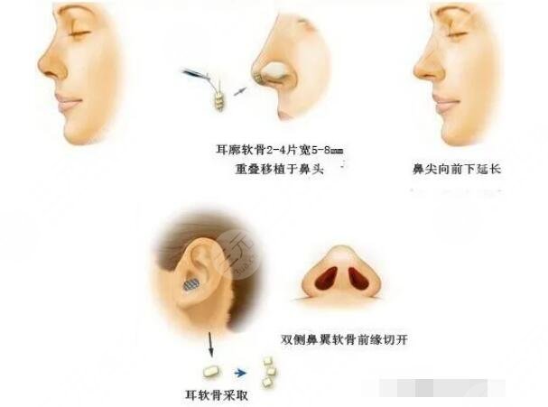 北京安貞醫(yī)院隆鼻失敗項目案例體驗反饋：