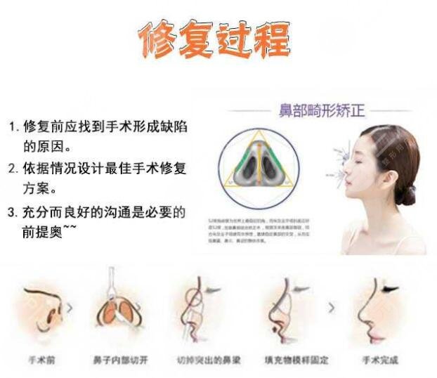 北京安貞醫(yī)院鼻整形科普