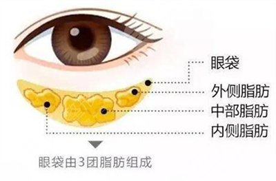 南京華美醫(yī)療美容醫(yī)院去眼袋案例