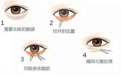南京華美醫(yī)療美容醫(yī)院去眼袋案例