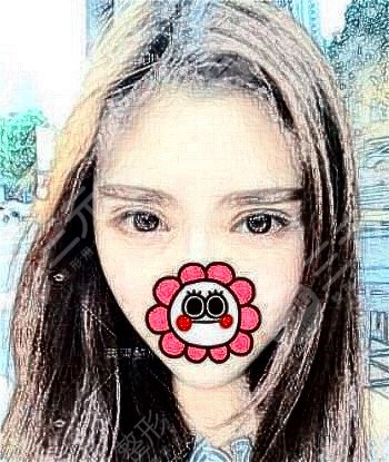 雙眼皮失敗修復(fù)案例