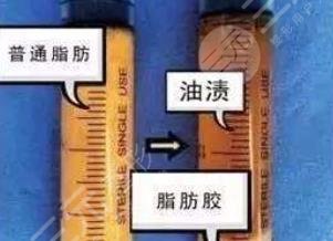 脂肪膠和自體脂肪區(qū)