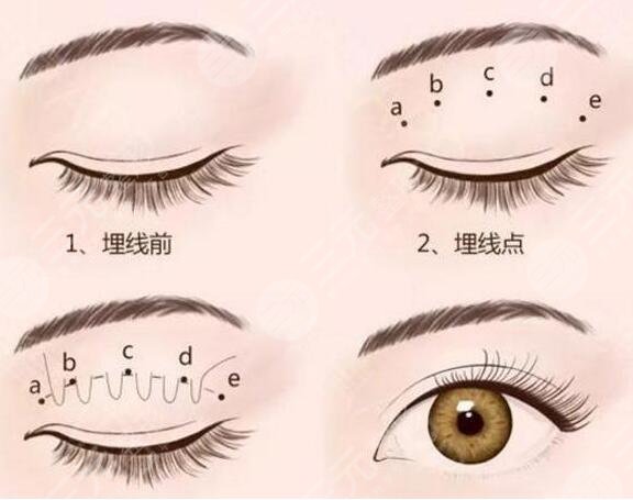 割雙眼皮后