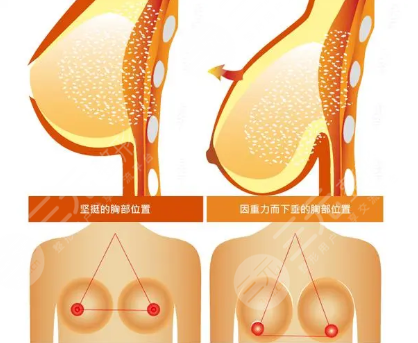 內(nèi)窺鏡隆胸和普通隆胸有什么區(qū)別？價格有差異！附術(shù)后護理~