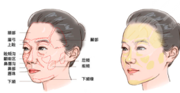 寧波雅韓自體填充果好不好？誠享面部填充恢復記錄