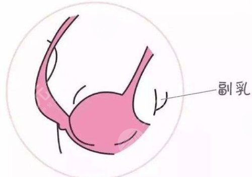 副乳手術(shù)有哪些注意事項(xiàng)?