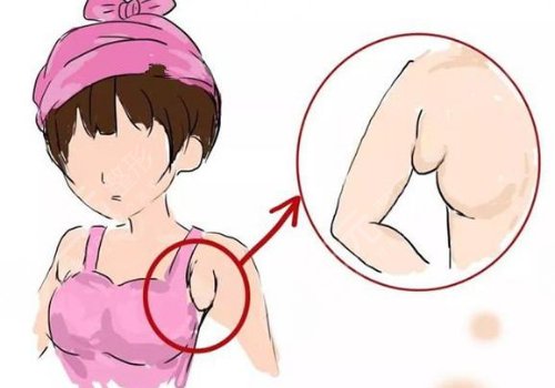 副乳怎么消除快并且有？副乳切除手術(shù)疼不疼？附上這幾點(diǎn)注意事項(xiàng)！
