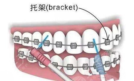 南京金屬矯正牙齒項目案例體驗反饋：
