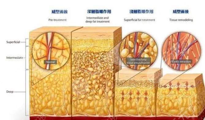 威塑抽脂