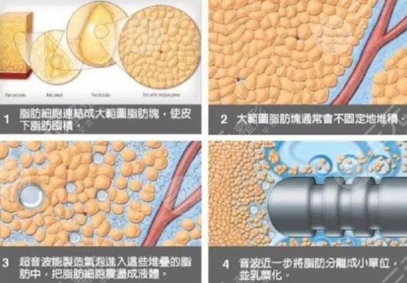 威塑抽脂
