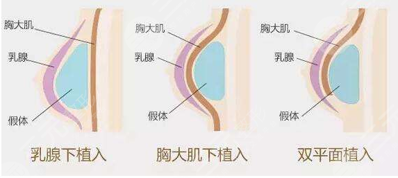 美國娜綺麗假體術前要做什么準備？