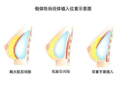 美國娜綺麗假體術后應該如何進行保養(yǎng)？
